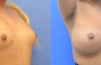 Side-by-side comparison of a person's chest before (left) and after (right) breast augmentation surgery, showing increased breast size and shape changes.