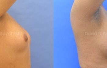 Side-by-side comparison of a person's chest before and after breast augmentation surgery, showing increased breast size and visible stretch marks after the procedure.