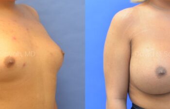 Side-by-side photos showing a woman's chest before (left) and after (right) breast augmentation, with significant increase in breast size.