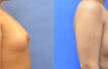 Side-by-side comparison of a woman's torso before (left) and after (right) breast augmentation against blue backgrounds.