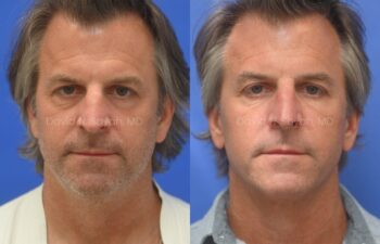 Side-by-side comparison of a middle-aged man before (left) and after (right) a cosmetic treatment, showing smoother skin and a more even complexion in the after image.