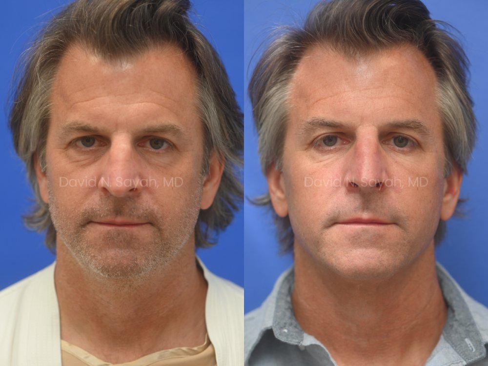 Side-by-side comparison of a middle-aged man before (left) and after (right) a cosmetic treatment, showing smoother skin and a more even complexion in the after image.