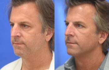 Side-by-side photos of a middle-aged man before and after a cosmetic procedure, showing changes in his nose and overall facial appearance.