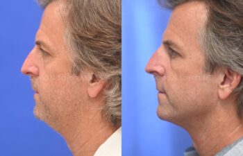 Side-by-side profile photos of a man before and after a cosmetic procedure, showing a more defined jawline and smoother neck in the after image.