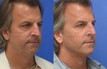 Side-by-side images of a middle-aged man before and after a cosmetic procedure, showing smoother skin and a more defined jawline in the "after" photo.