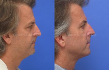 Side-by-side profile photos of a middle-aged man before and after rhinoplasty; the nose shape appears altered in the second image.