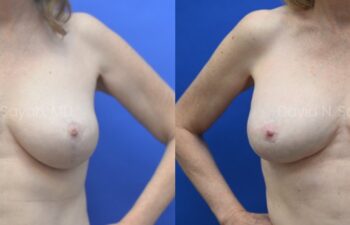 Breast Implant Exchange Before and After | Sayah Institute, front view