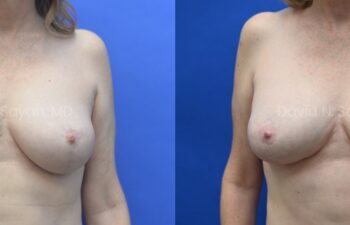Breast Implant Exchange Before and After | Sayah Institute, front view