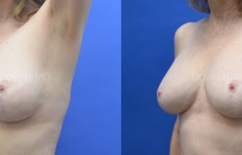 Breast Implant Exchange Before and After | Sayah Institute, left oblique view