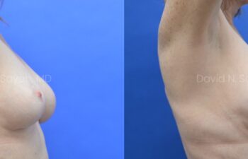 Breast Implant Exchange Before and After | Sayah Institute, right view