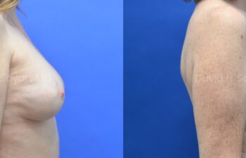 Breast Implant Exchange Before and After | Sayah Institute, right view
