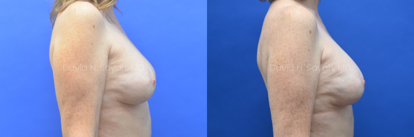 Breast Implant Exchange Before and After | Sayah Institute, right view
