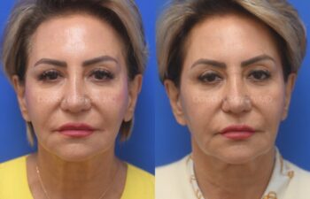 Side-by-side photos of a woman before and after a cosmetic procedure, showing changes in facial features and skin texture against a blue background.