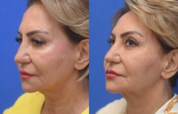 Side-by-side before and after photos of a woman showing facial changes, likely from a cosmetic procedure, against a blue background.