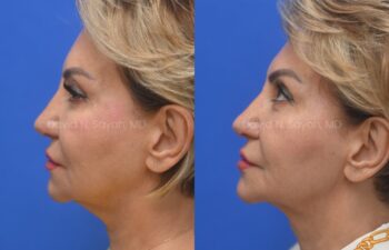 Side-by-side profile photos of a woman before and after a cosmetic procedure, showing changes in skin texture and facial contour against a blue background.