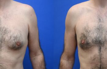 Side-by-side side-view comparison of a male chest before and after gynecomastia surgery, with the left image showing excess breast tissue and the right image showing a flatter, more contoured chest profile, front view.