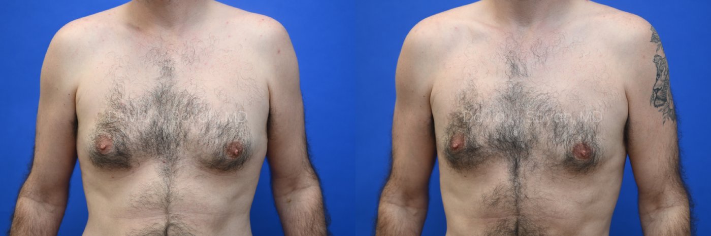 Side-by-side side-view comparison of a male chest before and after gynecomastia surgery, with the left image showing excess breast tissue and the right image showing a flatter, more contoured chest profile, front view.
