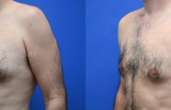 Side-by-side side-view comparison of a male chest before and after gynecomastia surgery, with the left image showing excess breast tissue and the right image showing a flatter, more contoured chest profile, left oblique view.