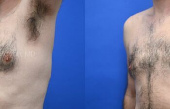 Side-by-side side-view comparison of a male chest before and after gynecomastia surgery, with the left image showing excess breast tissue and the right image showing a flatter, more contoured chest profile, left oblique view.