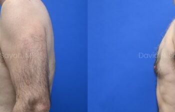 Side-by-side side-view comparison of a male chest before and after gynecomastia surgery, with the left image showing excess breast tissue and the right image showing a flatter, more contoured chest profile, left view.