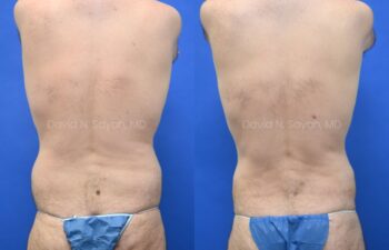 Liposuction and Male Breast Surgery Before and After | Sayah Institute