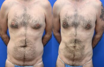 Liposuction and Male Breast Surgery Before and After | Sayah Institute