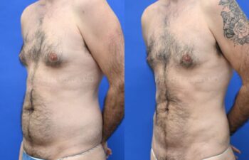 Liposuction and Male Breast Surgery Before and After | Sayah Institute