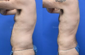 Liposuction and Male Breast Surgery Before and After | Sayah Institute