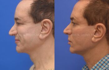 Side-by-side profile photos of a man before and after a cosmetic procedure, showing changes in jawline and neck definition against a blue background.