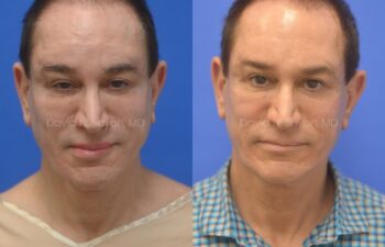 Side-by-side comparison of a man before and after a cosmetic procedure, showing changes in facial appearance against a blue background.