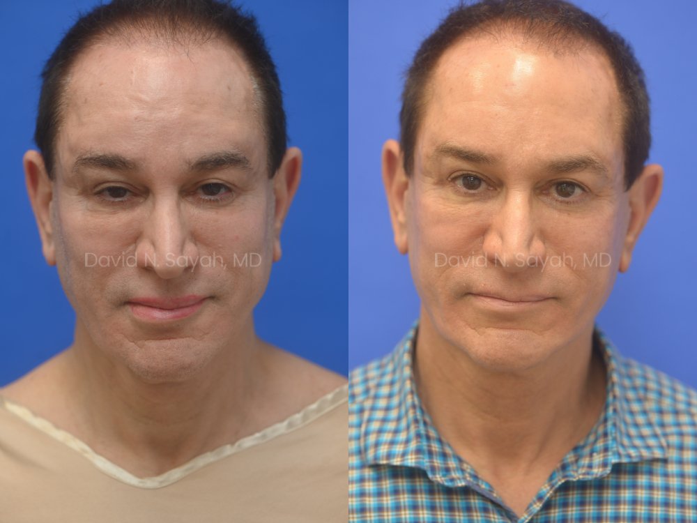 Side-by-side comparison of a man before and after a cosmetic procedure, showing changes in facial appearance against a blue background.