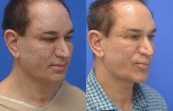 Side-by-side photos show a man before and after a cosmetic procedure, with smoother facial features and a change in skin tone and texture in the after image.