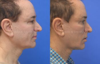 Side-by-side profile photos of a man before and after a cosmetic procedure, showing a more defined jawline and chin in the after image.