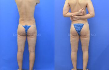 Before and after back view of male patient after body contouring with liposuction | Sayah Institute