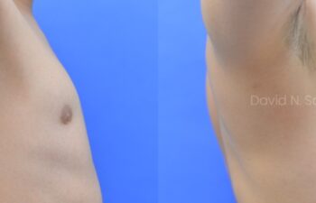 Before and after side view of male patient after body contouring with fat transfer to breasts | Sayah Institute
