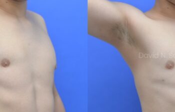 Before and after side view of male patient after body contouring with fat transfer to breasts | Sayah Institute