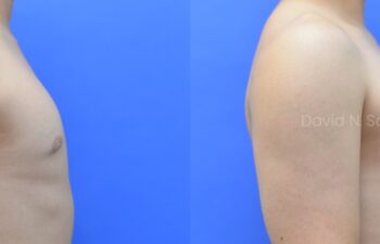 Before and after side view of male patient after body contouring with fat transfer to breasts | Sayah Institute