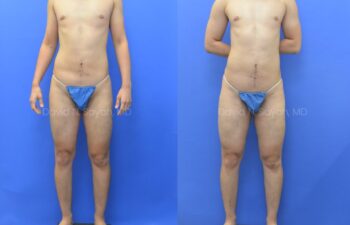 Before and after front view of male patient after body contouring with liposuction | Sayah Institute