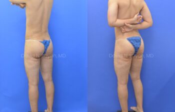 Before and after back view of male patient after body contouring with liposuction | Sayah Institute
