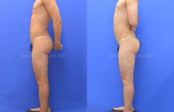 Before and after back view of male patient after body contouring with liposuction | Sayah Institute