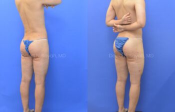 Before and after back view of male patient after body contouring with liposuction | Sayah Institute