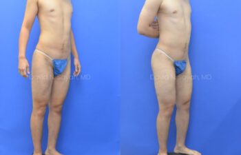 Before and after side view of male patient after body contouring with liposuction | Sayah Institute