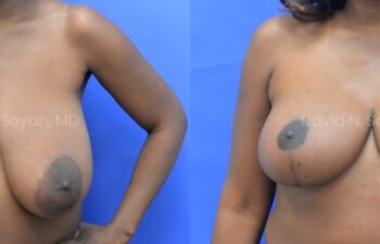 Breast Reduction Before and After | Sayah Institute