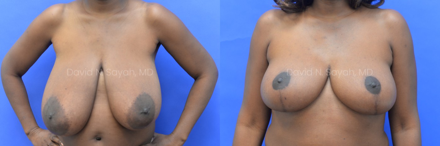 Breast Reduction Before and After | Sayah Institute