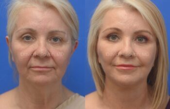 Facelift, Neck Lift, Fat Graph Lips and Face Before and After | Sayah Institute, front view