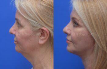 Facelift, Neck Lift, Fat Graph Lips and Face Before and After | Sayah Institute, left side view