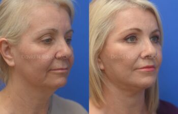 Facelift, Neck Lift, Fat Graph Lips and Face Before and After | Sayah Institute, right oblique view