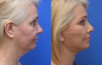 Facelift, Neck Lift, Fat Graph Lips and Face Before and After | Sayah Institute, right side view