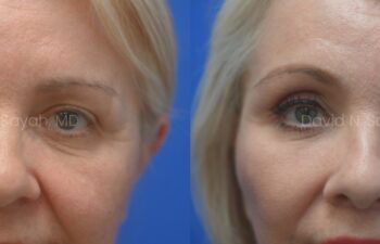 Facelift, Neck Lift, Fat Graph Lips and Face Before and After | Sayah Institute, front view