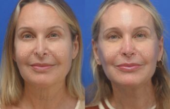 Facelift, Neck Lift, Lip Fat Grafting, Revison Rhinoplasty, Co2 laser Before ans After | Sayah Institute, front view
